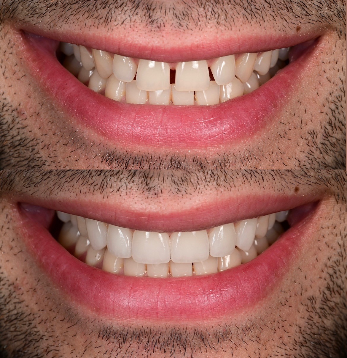 Invisalign patient transformation 2, before and after treatment