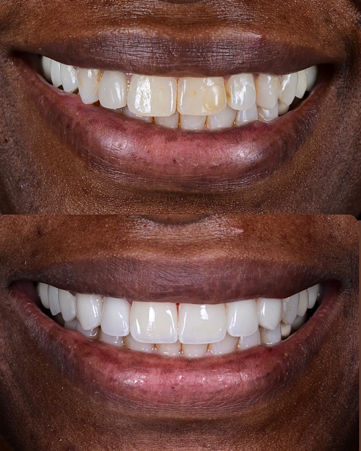Invisalign patient transformation 1, before and after treatment